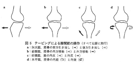 テーピングによる膝関節の操作